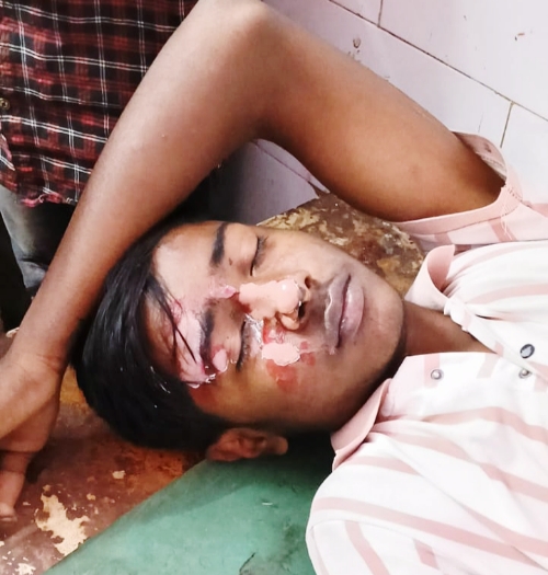 KAIMGANJ NEWS कुकर बना ‘बारूद’, तेज धमाके में किशोर झुलसा — रसोई में मचा हड़कंप, आंख बाल-बाल बची Picsart 26 02 13 06 44 22 250